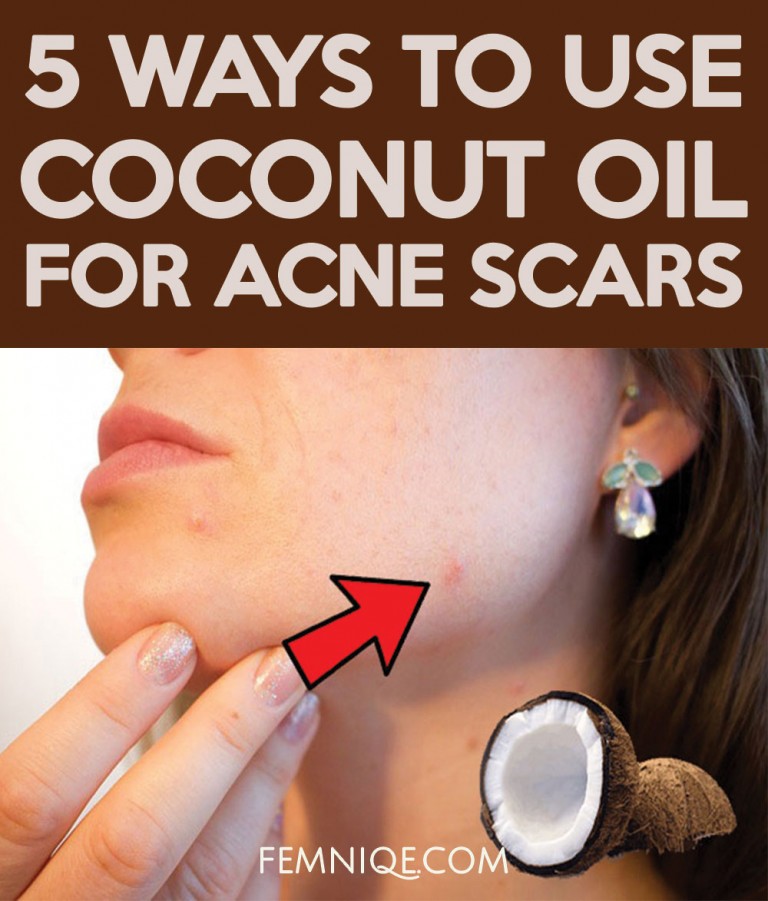 How To Use Coconut Oil For Acne Scars (5 Ways) - Femniqe